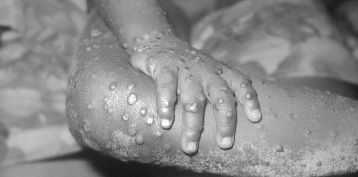 Monkeypox Outbreak - Health Crisis Grips Democratic Republic of Congo