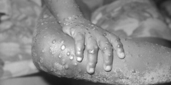 Monkeypox Outbreak - Health Crisis Grips Democratic Republic of Congo